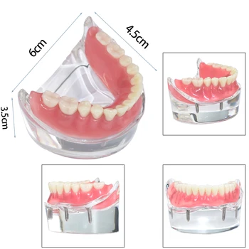 Зубной имплантат Модель зубов 4 Имплантата Съемный Мостовидный протез Модель нижней челюсти Обучение студентов-стоматологов